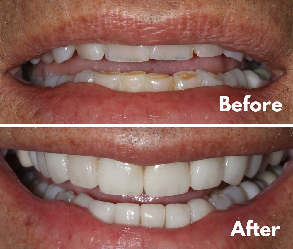 Veneers Before and After Musselman Dentistry Phoenix