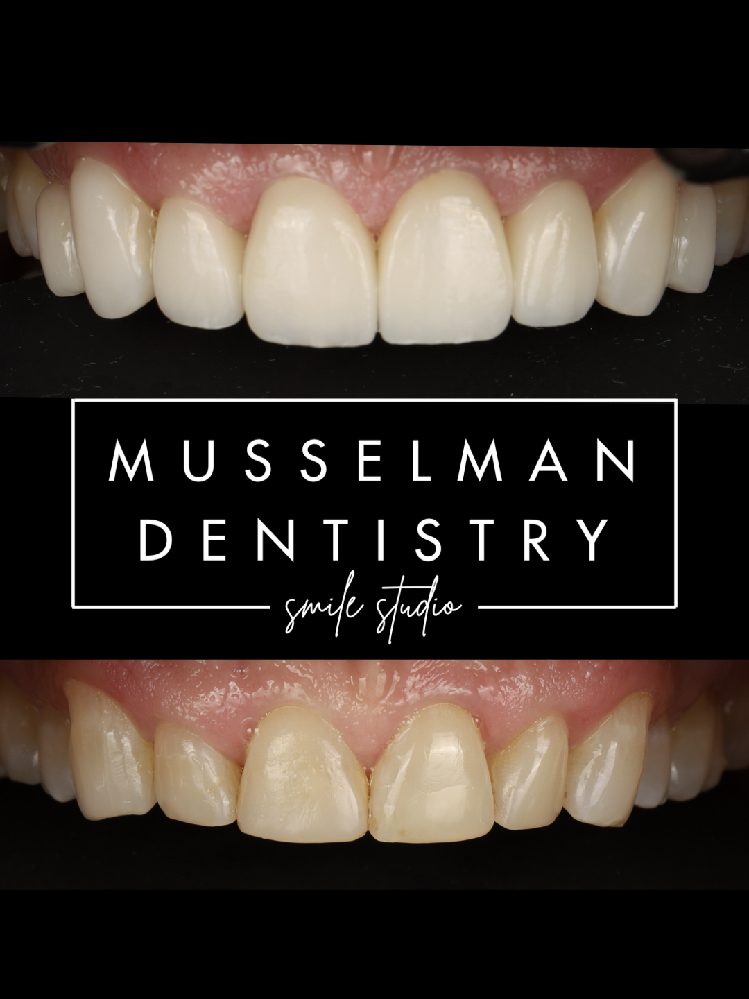 no prep veneers image 0