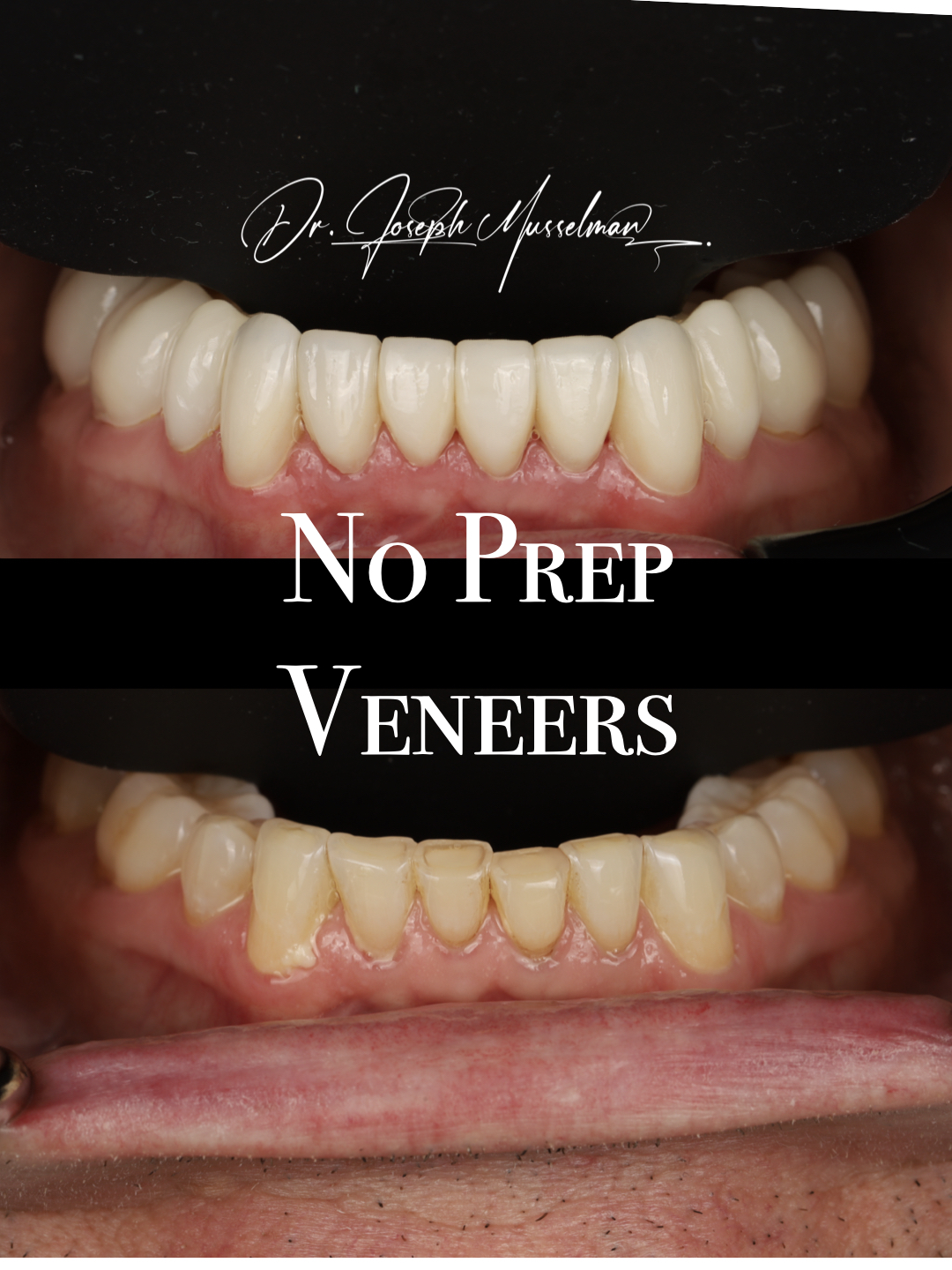 no prep veneers image 1